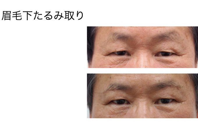 まぶたたるみ手術 眉下たるみ取り２か月の経過 静岡美容外科 橋本クリニック 院長ブログ