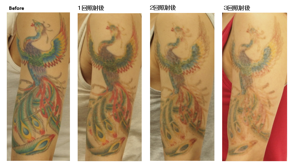 ピコレーザーによるカラータトゥー除去の経過と照射間隔などについて 静岡美容外科 橋本クリニック 院長ブログ