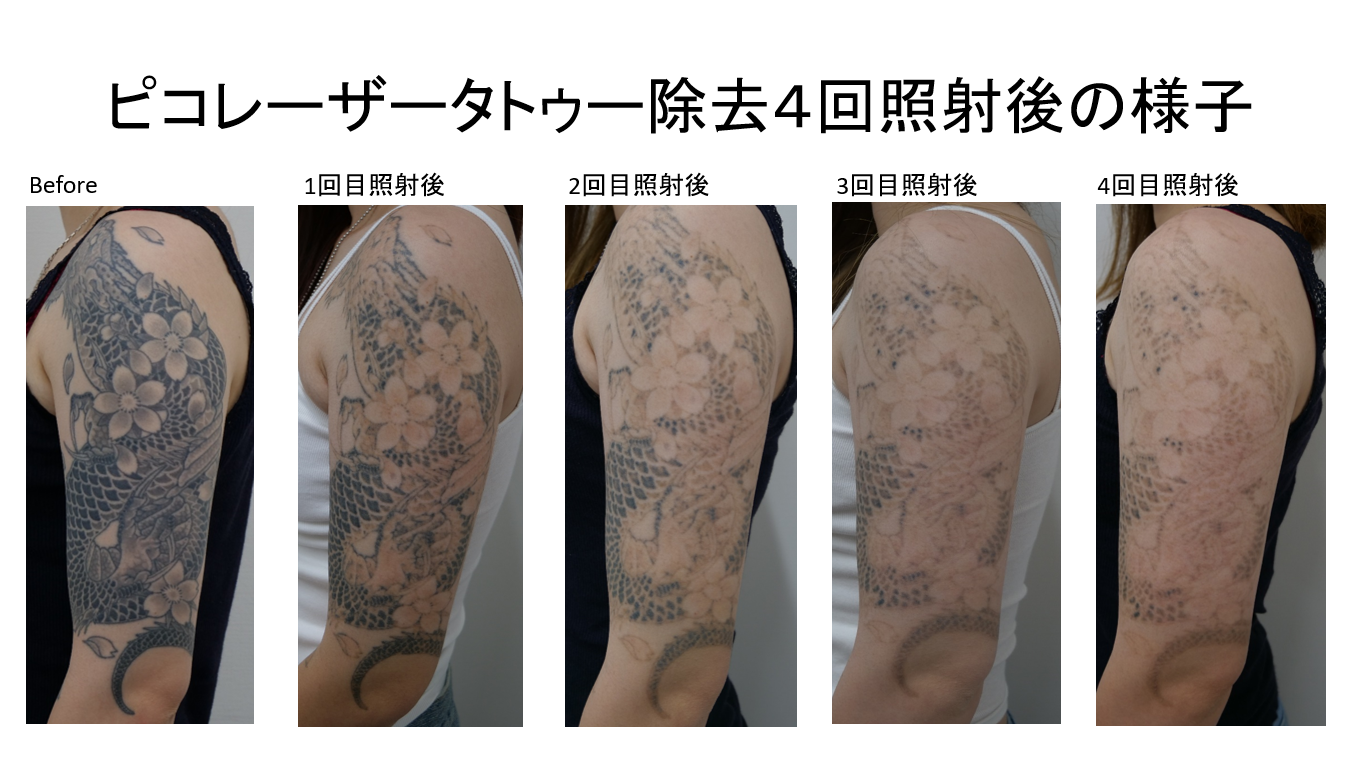 タトゥー除去のモニター様の紹介とエンライトン の導入のお知らせ 静岡美容外科 橋本クリニック 院長ブログ
