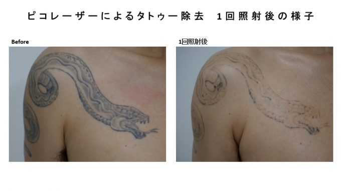 ピコレーザーによるタトゥー除去の経過報告です 静岡美容外科 橋本クリニック 院長ブログ
