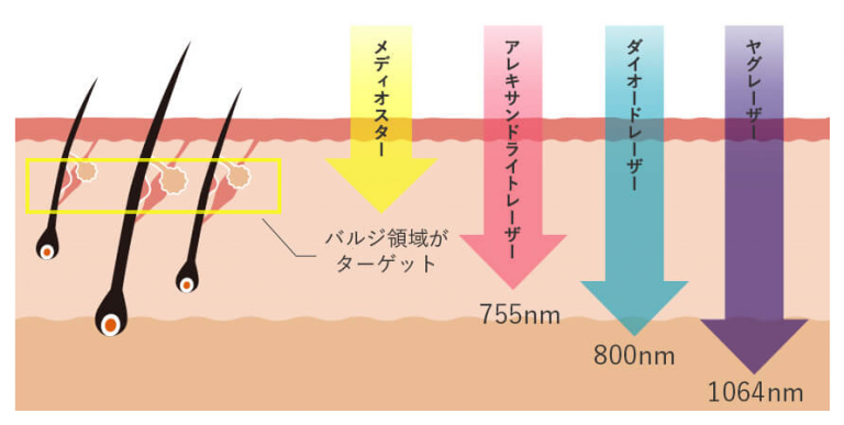 顔のレーザー脱毛は痛いですか?