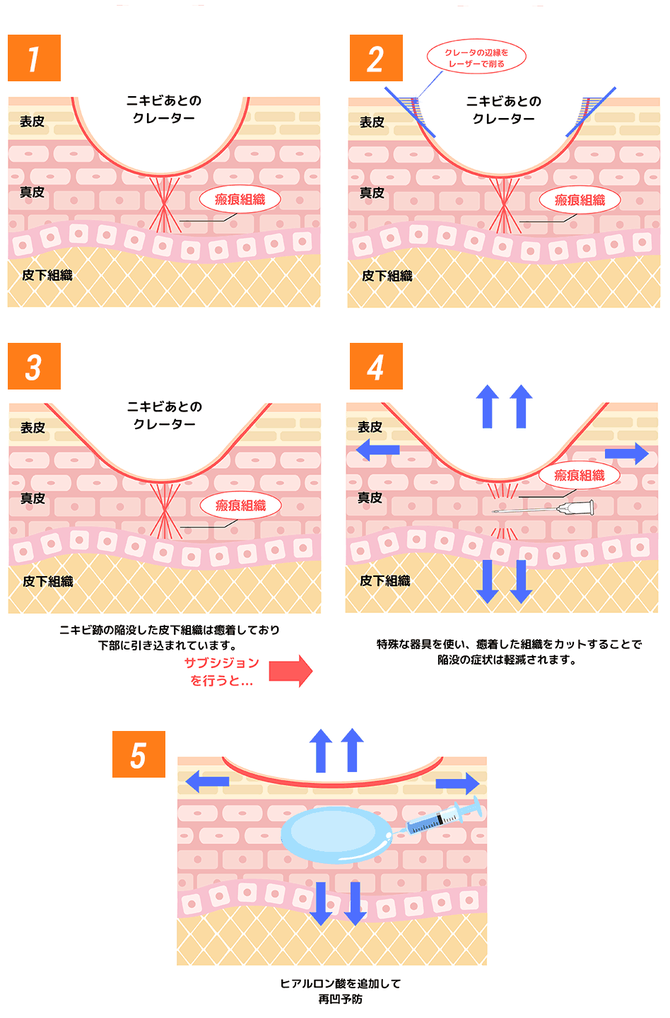 ニキビ跡（クレーター）