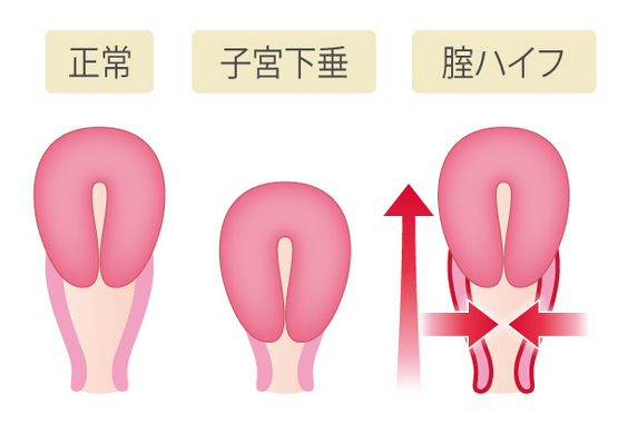 膣ハイフ(HIFU)の図2