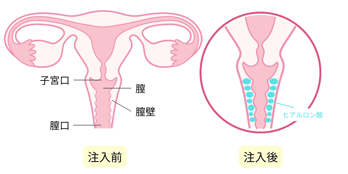 膣HA