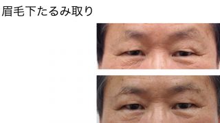 まぶたたるみ手術（眉下たるみ取り２か月の経過）
