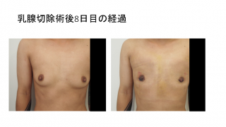 乳腺除去術後10日目の経過