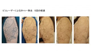 ピコレーザーによるタトゥー除去の経過：静岡美容外科　橋本クリニック