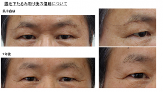 眉毛下たるみ取りの1年後の経過・傷の様子を含めて