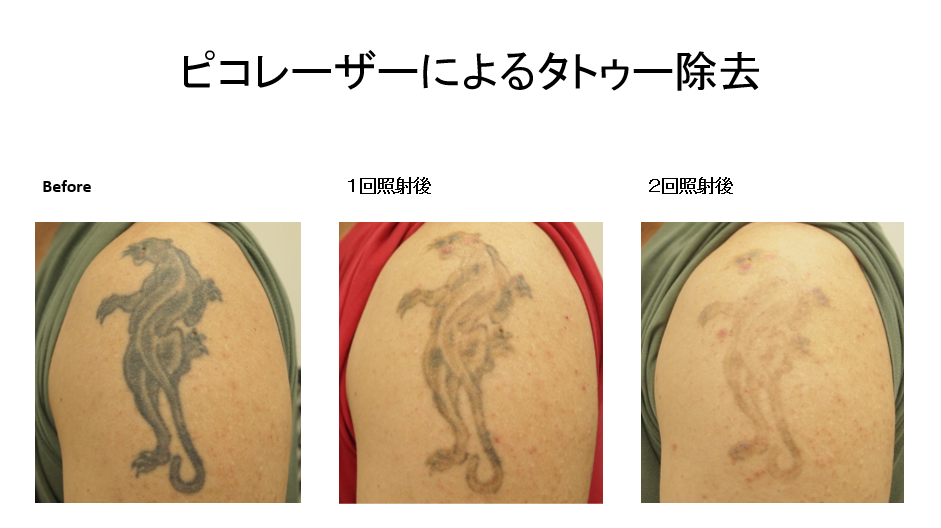 ピコレーザーで行うタトゥー除去の経過写真のご紹介です！