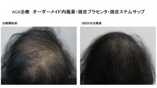 女性の薄毛（FAGA）治療のモニター様3か月目の様子です。