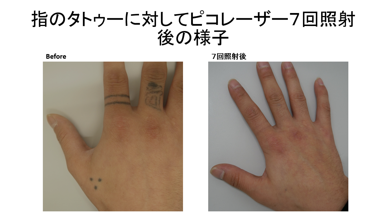 指のタトゥーに対してピコレーザーを用いたタトゥー除去の経過