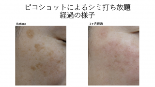 ピコショットによるシミ打ち放題の経過です。