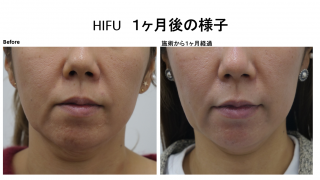 新型HIFU・ウルトラセルQプラスのモニター様の施術後１か月の経過です。