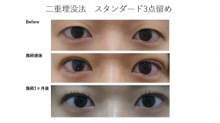 2019年度版！当院の二重手術・埋没法について！