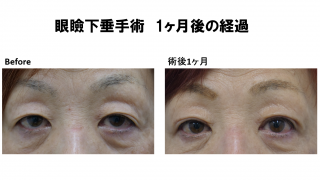 眼瞼下垂術後1か月の経過報告です。