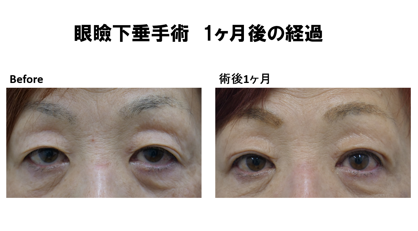 眼瞼下垂術後1か月の経過報告です。