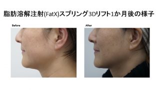 新型脂肪溶解注射FATX・スプリング３Dリフトモニター様の紹介です。