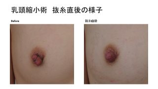 乳頭縮小術の術後経過報告です。乳頭縮小手術Before・After