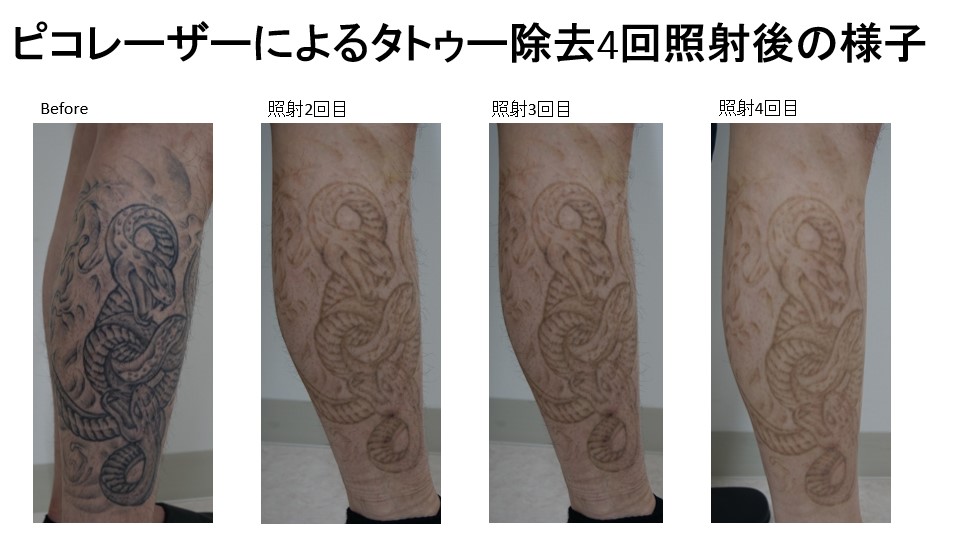 ピコレーザーで行うタトゥー、刺青除去の４回目のモニター様の紹介です。