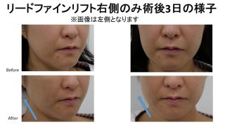 リードファインリフトの新しい試み