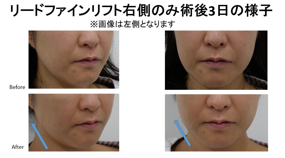 リードファインリフトの新しい試み