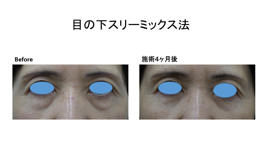 切らない目の下たるみ取り・スリーミックス法術後4ヶ月の経過です。