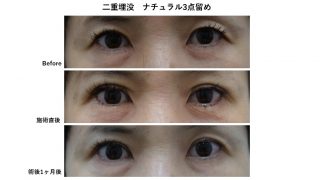 二重埋没ナチュラル3点留めのモニター様の紹介です。