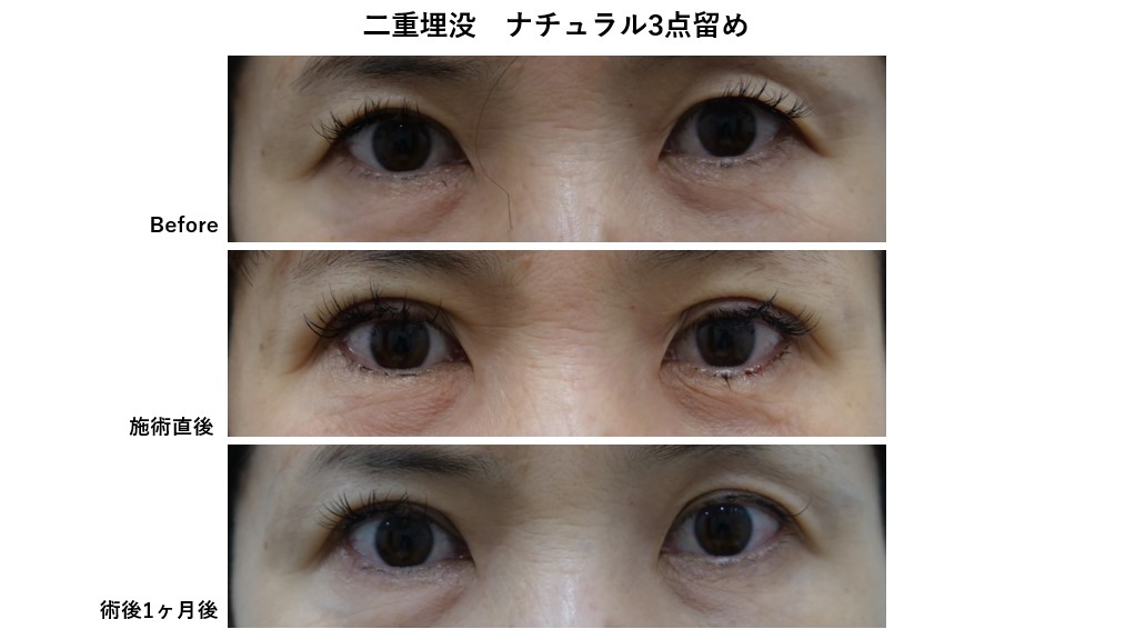 二重埋没ナチュラル3点留めのモニター様の紹介です。