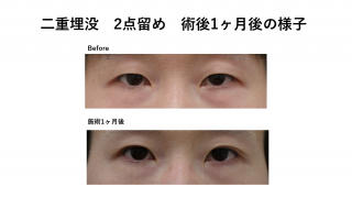 埋没法2点留めをされたモニター様のご紹介