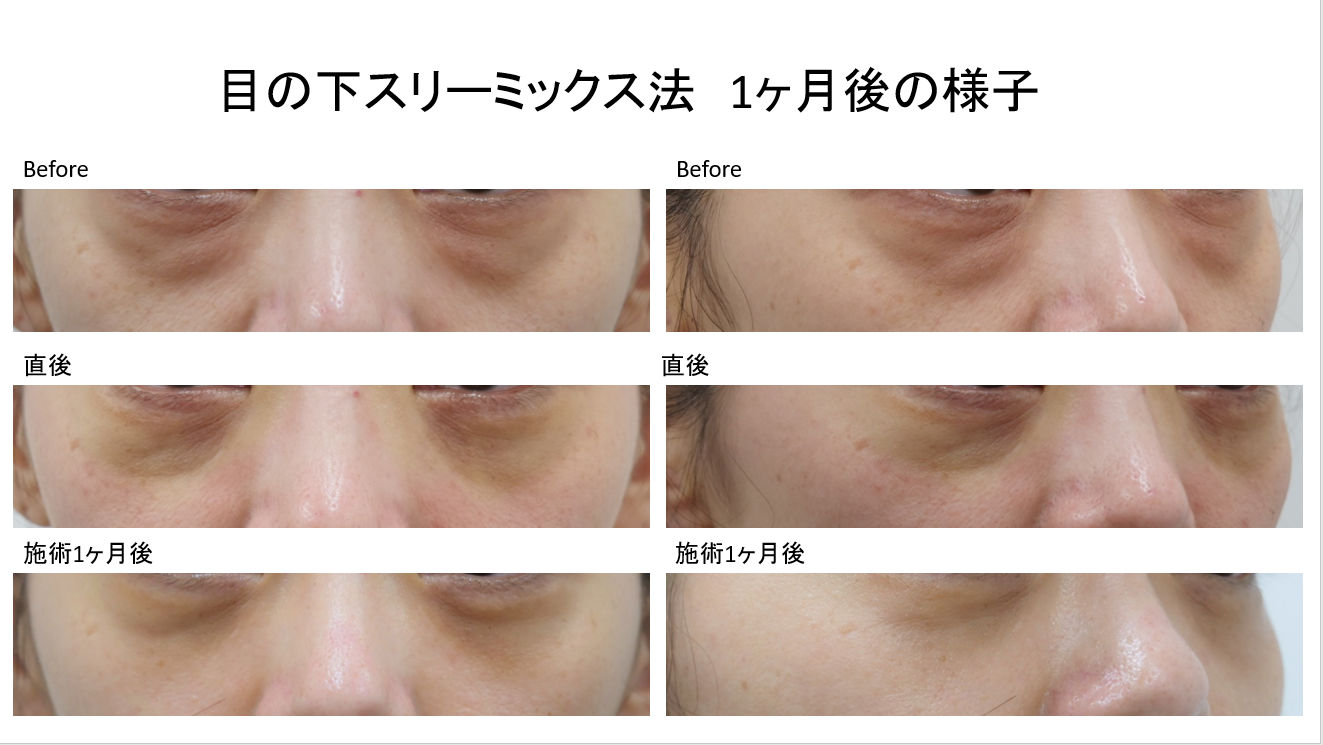切らない目の下たるみ取り（スリーミックス法）の術後1か月の症例写真の紹介