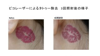 タトゥー除去（赤・黒)ピコレーザー照射後の経過報告です！　エンライトンⅢ