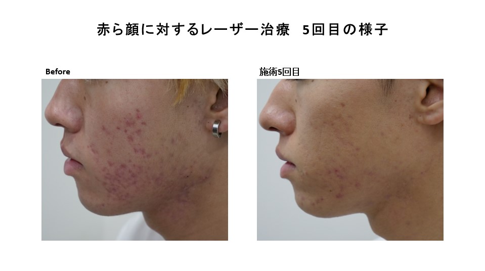 ニキビの赤み治療・ジェントルMAXpro照射の経過の紹介です。