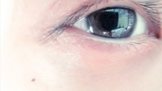 二重ナチュラル2点留めと切らない目の上脂肪取りの術中の様子です。
