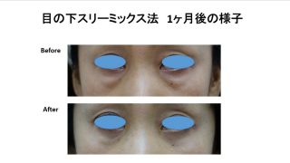 目の下脂肪取り(スリーミックス法)のモニター様の紹介です。