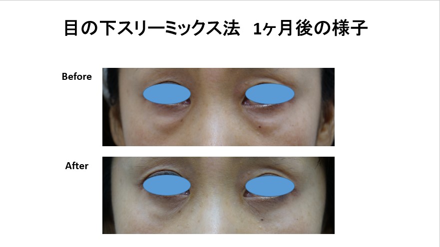 目の下脂肪取り(スリーミックス法)のモニター様の紹介です。