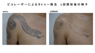 ピコレーザーによるタトゥー除去の経過報告です。
