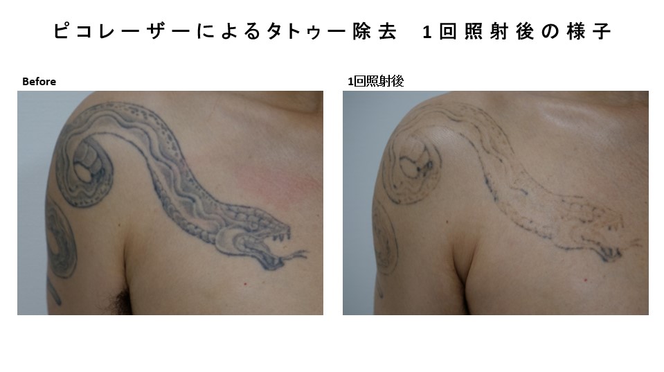 ピコレーザーによるタトゥー除去の経過報告です。