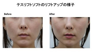 テスリフトソフトの施術後1ヶ月の経過の報告です！