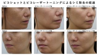 美容クリニックで行う丁寧なシミ治療②
