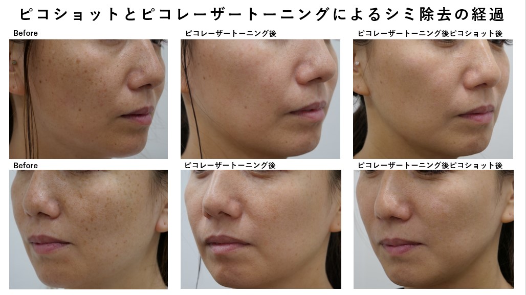 美容クリニックで行う丁寧なシミ治療②