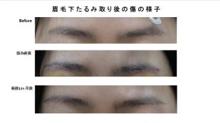 眉毛下たるみ取りの傷の様子（術後11か月後）