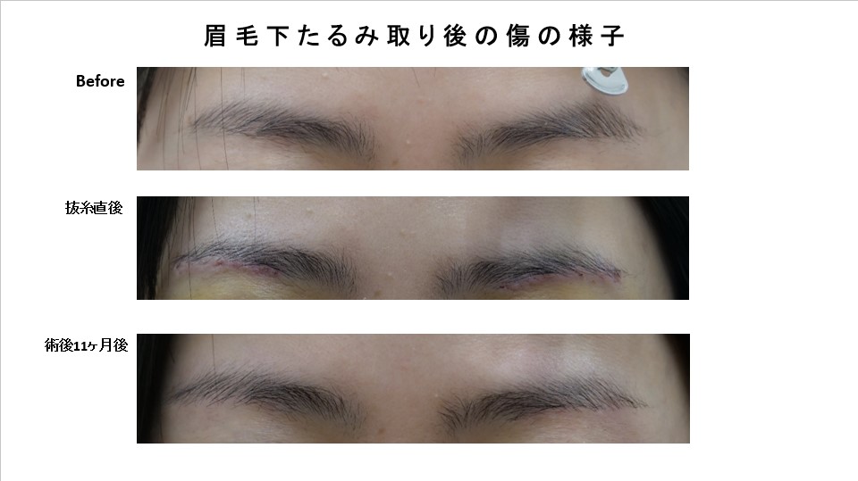眉毛下たるみ取りの傷の様子（術後11か月後）