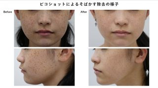 ピコショットによるそばかす(雀卵斑)除去の様子