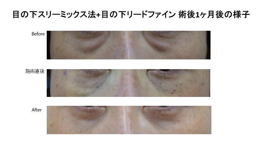 目の下スリーミックス法+目の下リードファイン術後1ヶ月後の様子