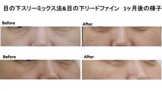 目の下スリーミックス法と目の下リードファイン併用施術経過です！