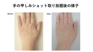 手の甲のピコショット（シミ除去）の経過報告です