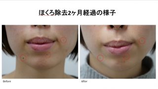 当院のほくろ除去後の経過報告です。