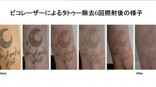 ピコレーザー（エンライトンⅢ）による足首のタトゥー除去の経過報告です!