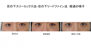 目の下スリーミックス法に目の下リードファインを追加すると良い3つの理由！　術後1か月の症例を踏まえて