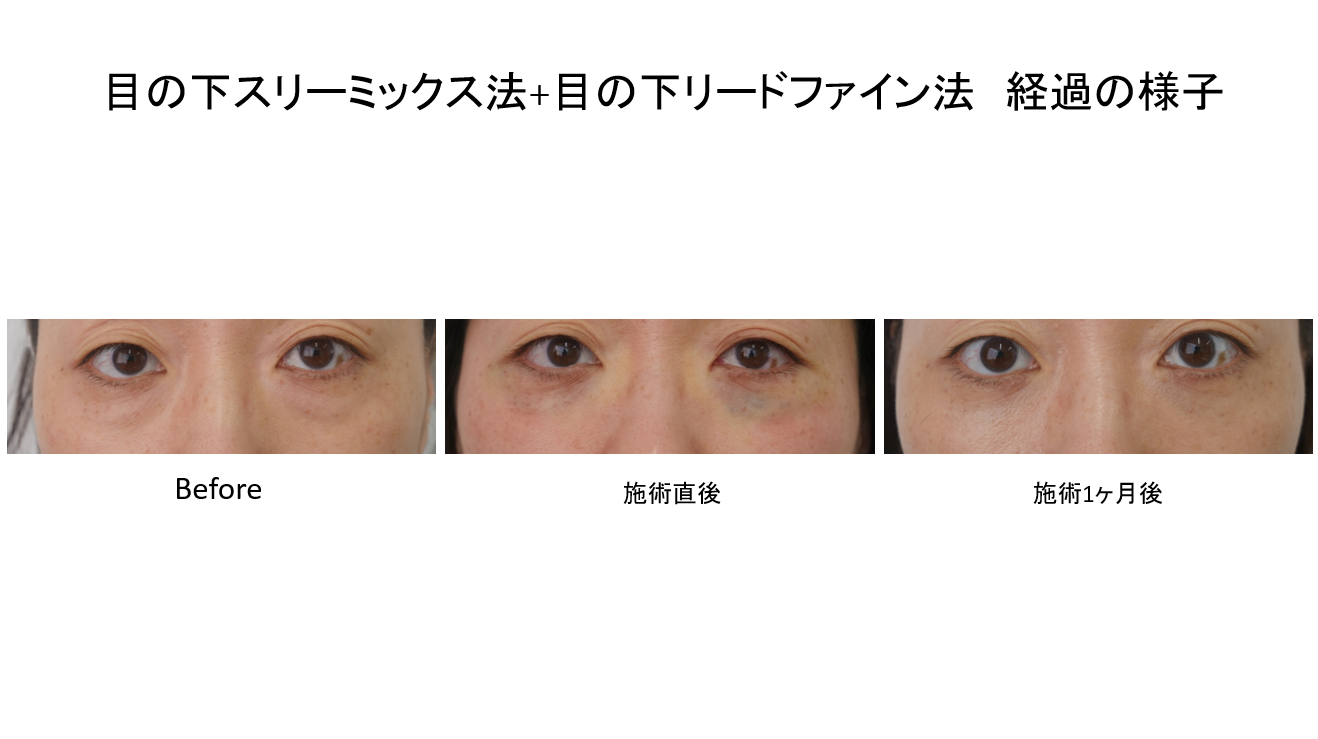 目の下スリーミックス法に目の下リードファインを追加すると良い3つの理由！　術後1か月の症例を踏まえて
